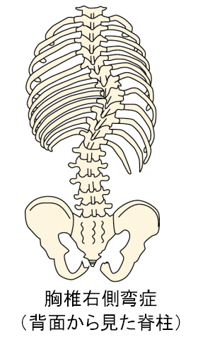 方 治し 側 弯症