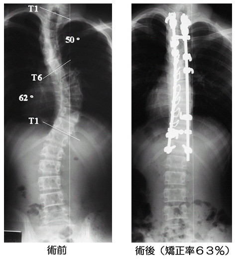 第1回 脊柱側弯症について 脊椎手術 Com