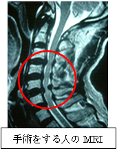 手術 性 症 頚椎 脊髄 症 頚椎症、頚椎ヘルニアの手術のリスクと後遺症