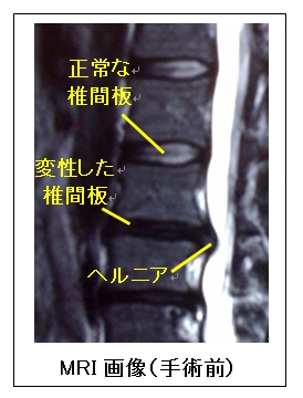 手術 椎間板 ヘルニア