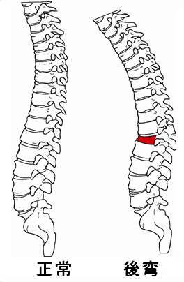 腰椎 第 圧迫 骨折 一 「第一腰椎圧迫骨折」に関するQ＆A
