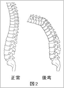 図2 後弯症