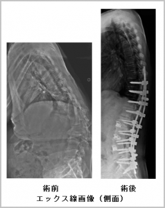 エックス線画像（側面）