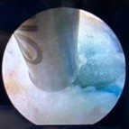 FESS：内視鏡の映像